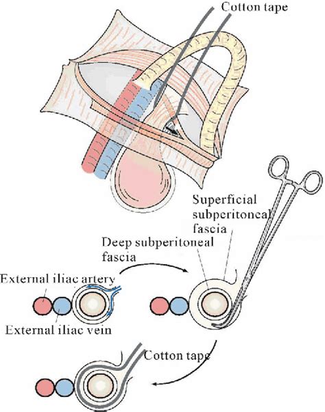 Figure 2 From Femoral Hernia A Review Of The Clinical Anatomy And