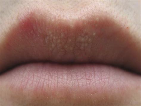 Fordyce Spots On Lips Treatment Change Comin