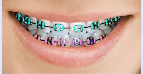 Teal And Purple Colors For Your Braces Or Brackets Dental Braces