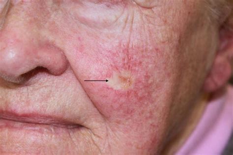 Morphoeic Basal Cell Carcinoma