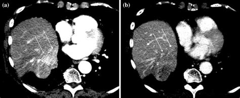 A 73 Year Old Male With Hcc In Liver Segment 7 Was Treated With Sbrt