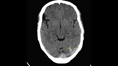 Trombose Venosa Cerebral Youtube