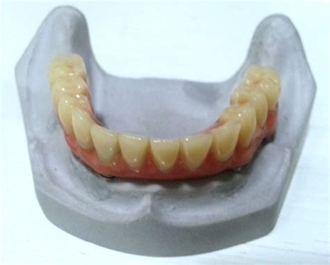 What Are Fixed Dentures Fixed Dentures Pictures Non Removable
