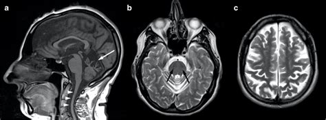 Brain Mri Findings In A 45 Year Old Female Arsacs Patient A