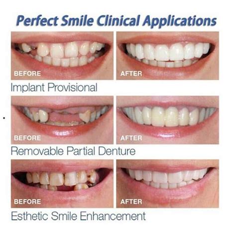 Only 1599 Instant Smile Veneer Upper And Lower Included