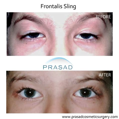 ptosis surgery droopy eyelid new york specialist