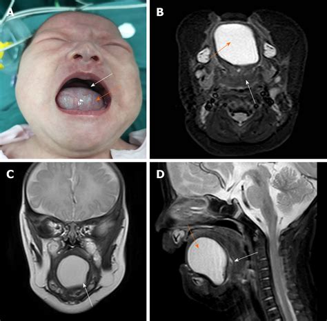Two Sequential Surgeries In Infant With Multiple Floor Of The Mouth