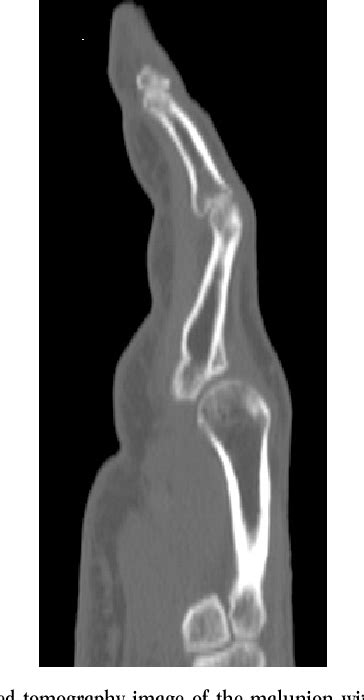 Figure 2 From Corrective Osteotomy And Local Bone Grafting For Extra