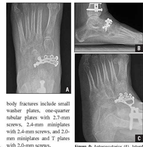 PDF Acute fractures of the tarsal navicular. | Semantic ...