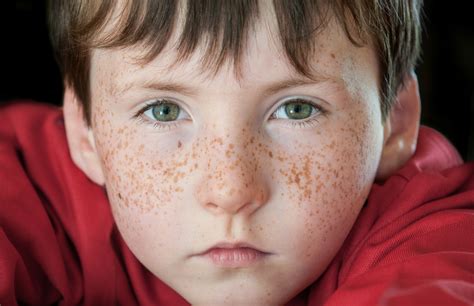 When To Worry About Your Freckles What To Look For And When To Seek