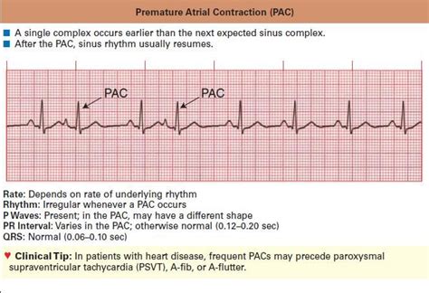 Characterized By Premature Heartbeats Originating In The Atria While