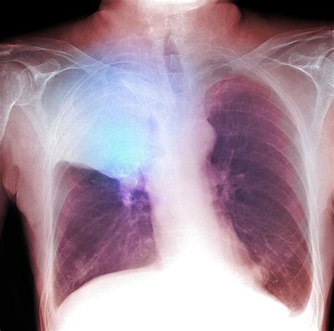 lung cancer x ray photograph by du cane medical imaging ltd fine art america