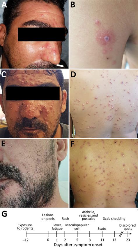 Monkeypox Scars Other Viral Infections Of The Skin Springerlink