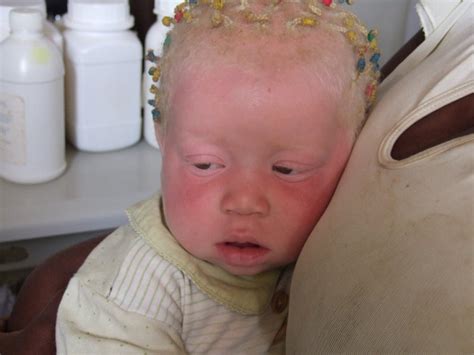 Sintomas Del Albinismo