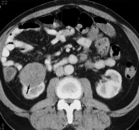 Renal Lymphoma Ct Patterns With Emphasis On Helical Ct Radiographics