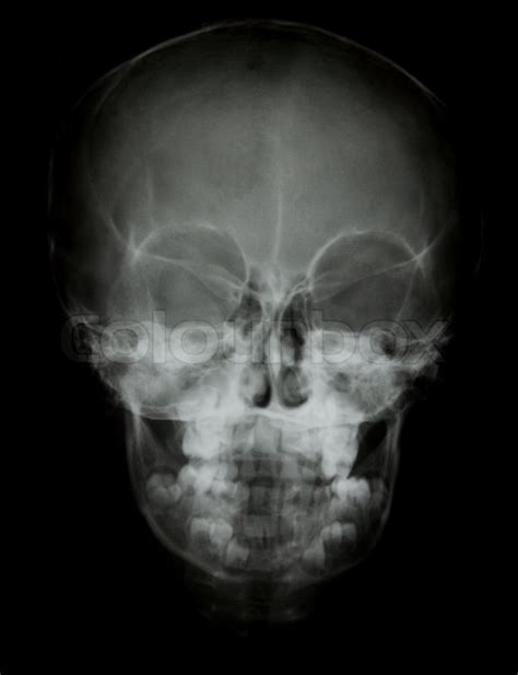 Front Face Skull X Ray Image Stock Photo Colourbox