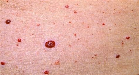What causes campbell de morgan spots or blood spots? CAMPBELL DE MORGAN SPOTS (CHERRY ANGIOMAS) - Salon Compass