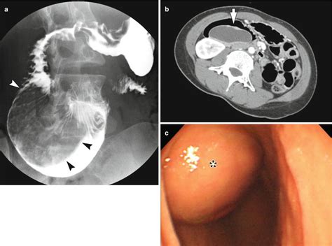 Benign Structural And Functional Abnormality Of The Stomach And Duodenum Radiology Key