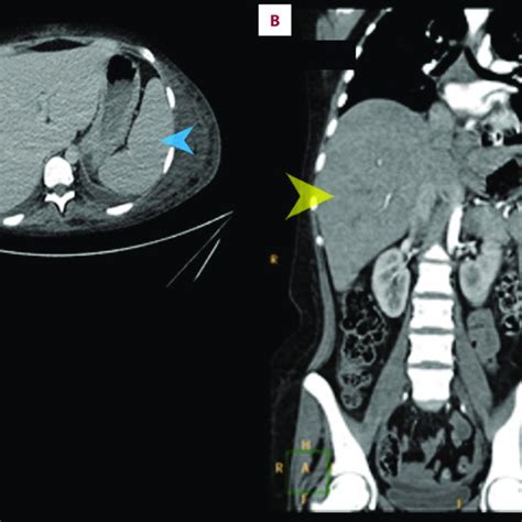 A Axial Abdominal Ct Scan Showing Enlarged Spleen Blue Arrow And