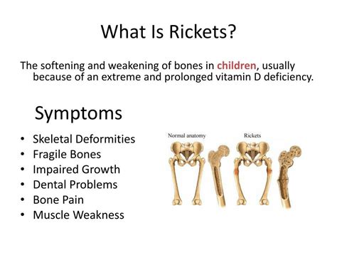 Ppt Rickets Disease Powerpoint Presentation Free Download Id2568458