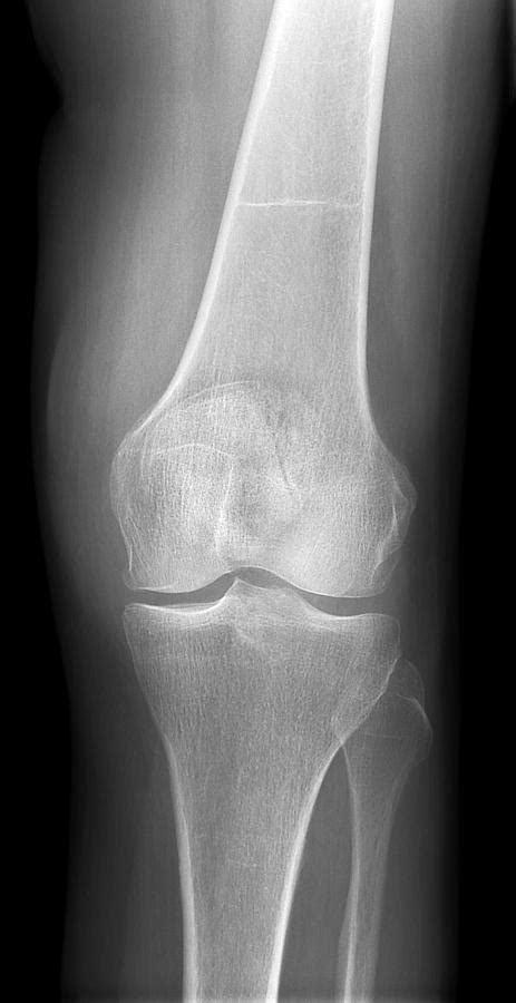 Arthritic Knee X Ray Photograph By Du Cane Medical Imaging Ltd