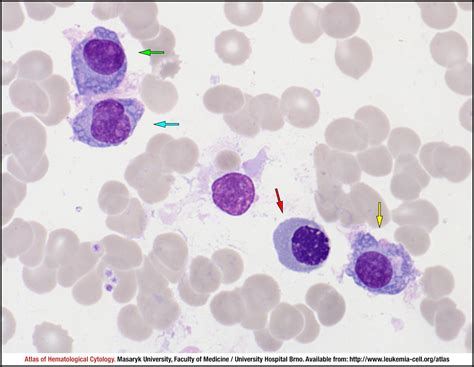 Plasma Cell Leukaemia Cell Atlas Of Haematological Cytology