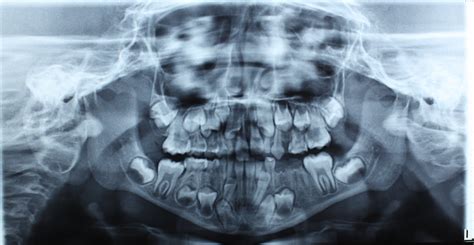 Radiografia Panorâmica Evidenciando Dentição Mista E Presença De