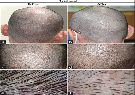 Demodex Folliculitis Of The Scalp Successfully Treated With
