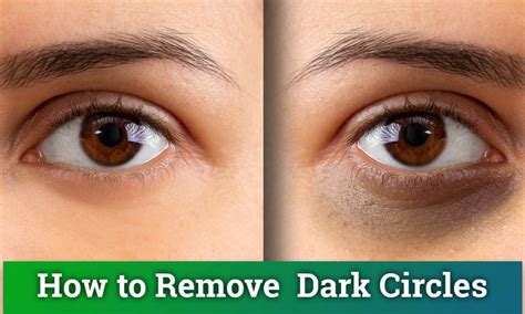 How To Reduce Dark Circles Beneath Your Eyes