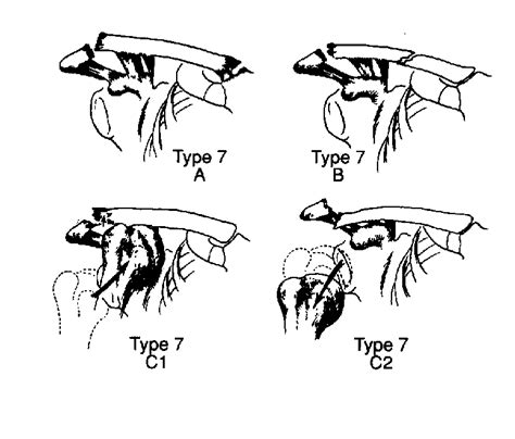 Expanded Classification Of Acromioclavicular Joint Injury 30