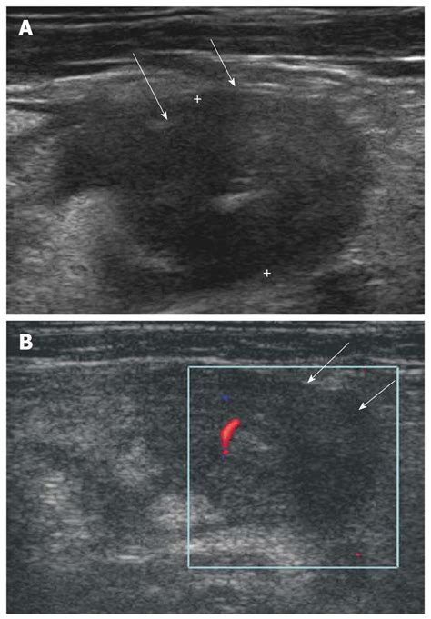 Ultrasonography Of Normal And Abnormal Appendix In Children