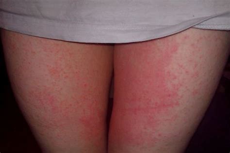 The rash are most common due to poor hygiene, which leaves this part of the body as a good spot for many different. Pin di Health and Fitness