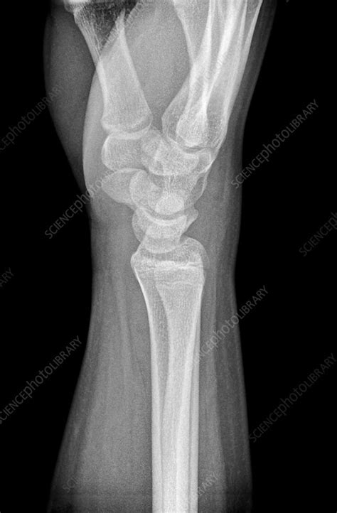 Fractured Scaphoid Wrist Bone X Ray Stock Image C0386655