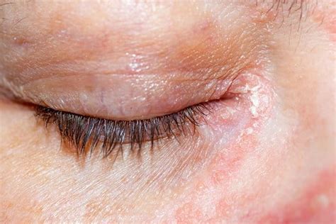 Dry Skin Around The Eyes Dry Eyelids Eucerin