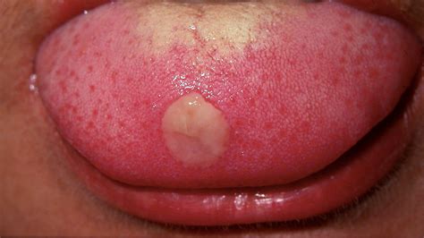 Tongue Bumps Enlarged Papillae And Other Problems