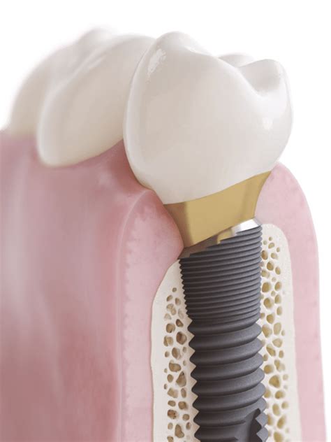 Osseospeed Profile Ev Astra Tech Implant System Dentsply Sirona