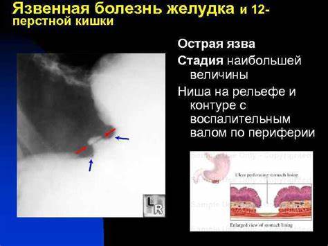 Острая язва диета Рентгенодиагности ка язвенной болезни желудка Кафедра лучевой диагностики Рентгенодиагности ка язвенной болезни желудка Кафедра лучевой диагностики Острая язва диета