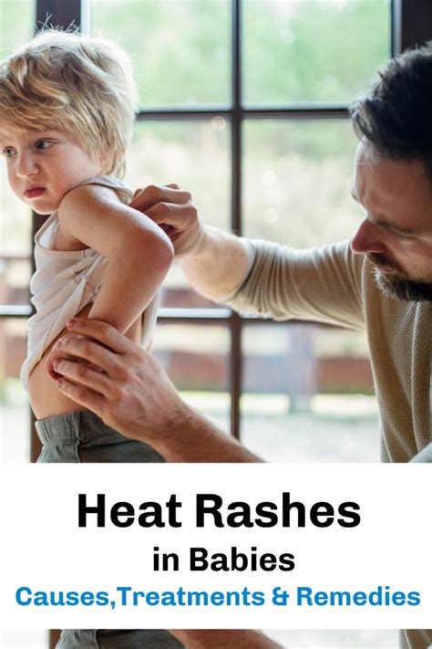 Heat Rashes In Babies Causes Treatments And Remedies