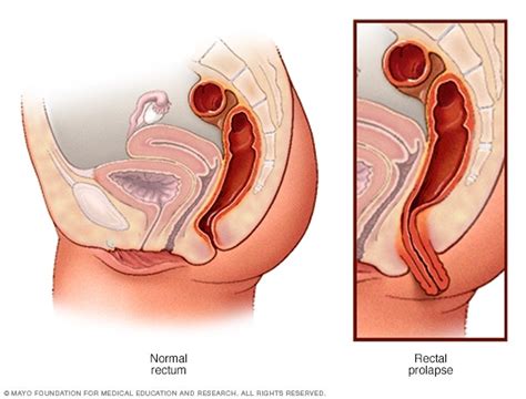 Rectal Prolapse Symptoms And Causes Mayo Clinic