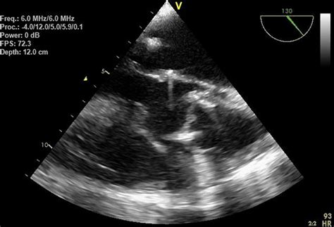 Complete Dehiscence And Unseated Prosthetic Aortic Valve Causing Severe