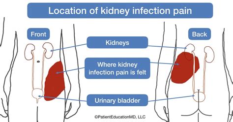 Kidney Infection Symptoms Patienteducationmd