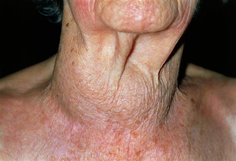Elderly Womans Swollen Neck Due To Thyroid Cancer Photograph By Dr P