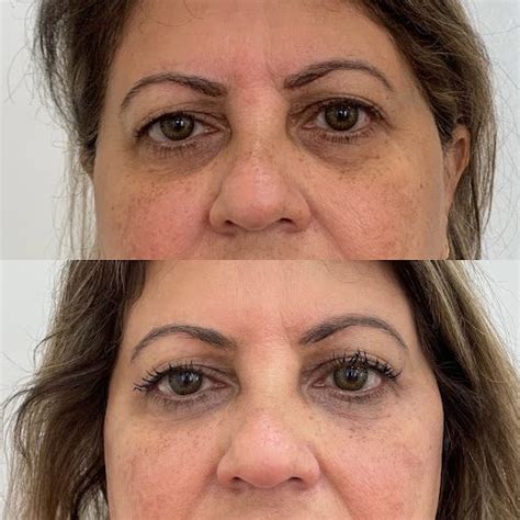 Eye Filler Before And After Beauty Boost Med Spa Inc®