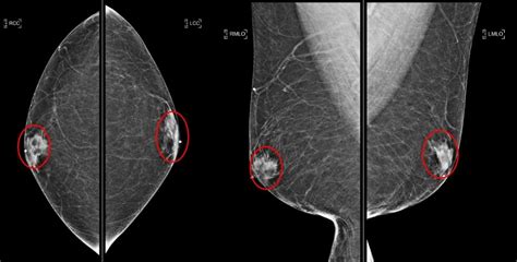 Cureus Hematoma Mimicking Breast Cancer On Ct Scan And Breast