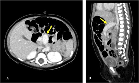 Abdominal Contrast Enhanced Computed Tomography Ct Findings Axial