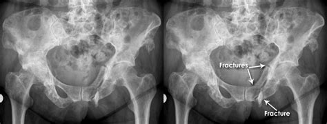 Trauma X Ray Axial Skeleton Gallery 2 Pelvis Pathological Fracture