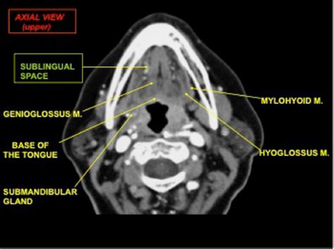 Review Of Imaging Anatomy And Pathology Of The Floor Of The Mouth