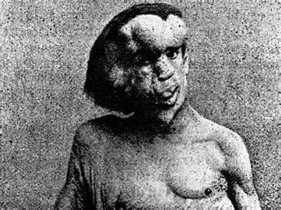 The elephant man was a commercial success and a critical hit. Drug causing 'elephant man' side effect is back - Business ...