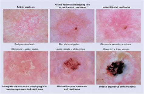 Progression Model Of Keratinocytes Skin Cancer Dermoscopy Reveals