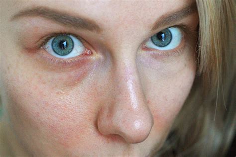 How To Get Rid Of Broken Capillaries Of The Face Bellatory